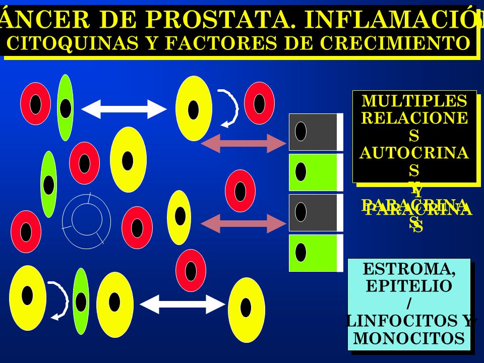 cómo el cáncer de próstata causa inflamación reaction